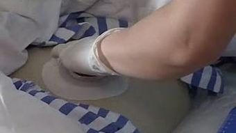 人工造瘘袋更换视频,人工造瘘袋更换操作步骤详解